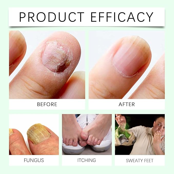 7 Days Nail Fungus Treatment With Tea Tree and Ginger for Toenails